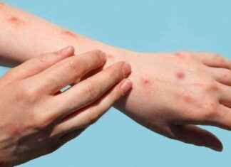 Mapping the Hotspots: London Borough Tops Mpox Cases Countrywide news-21082024-163021