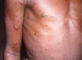 Spain on High Alert as Brits Warned of Mpox Cases: London Business News news-24082024-235526